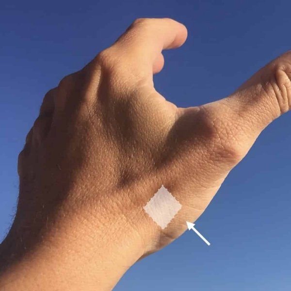 Tratamiento de Rizartrosis en Santa Cruz