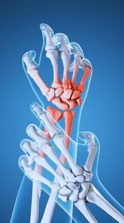 Lesiones de Muñeca y Mano
